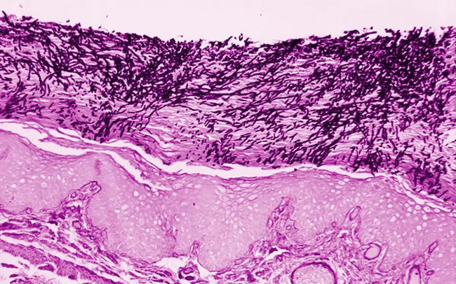 WHO lần đầu xác định bệnh nấm là mối đe dọa với sức khỏe con người