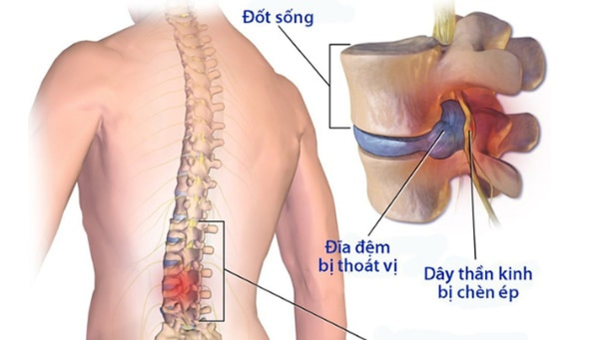 Làm thế nào để giảm nguy cơ bị bệnh đau thắt lưng?