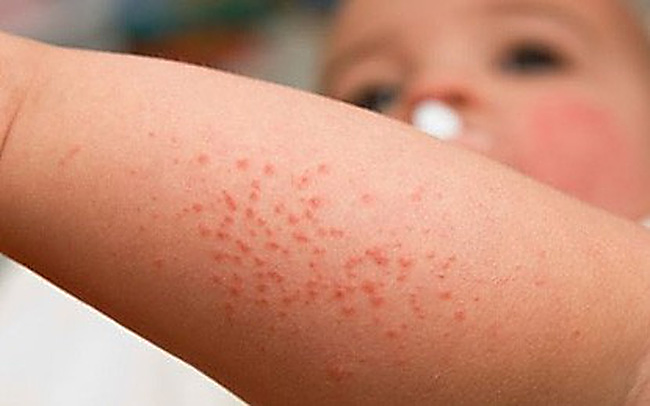 Hà Nội thêm hơn 1.000 ca sốt xuất huyết trong một tuần, dịch vẫn diễn biến phức tạp